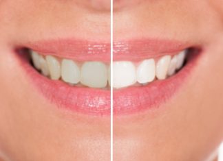 Zubar moli ljude da nikako ne izbeljuju zube na ovaj način: „Ostaćete bez zuba“ zubar-moli-ljude-da-nikako-ne-izbeljuju-zube-na-ovaj-nacin:-„ostacete-bez-zuba“