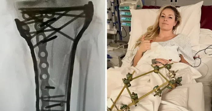 sraf-do-srafa,-ovako-sada-izgleda-noga-lindzi-von-/foto/