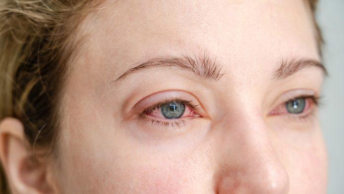 crvene-oci-nakon-budenja:-optometrista-otkriva-moguce-uzroke-krvavih-beonjaca