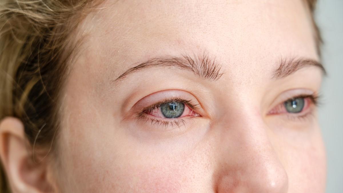 crvene-oci-nakon-budenja:-optometrista-otkriva-moguce-uzroke-krvavih-beonjaca crvene-oci-nakon-budenja:-optometrista-otkriva-moguce-uzroke-krvavih-beonjaca