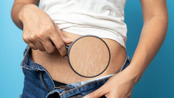 strije-–-nocna-mora-svake-zene,-mogu-se-javiti-minimum-dva-puta-u-zivotu:-zasto-nastaju-i-kako-mogu-da-nestanu