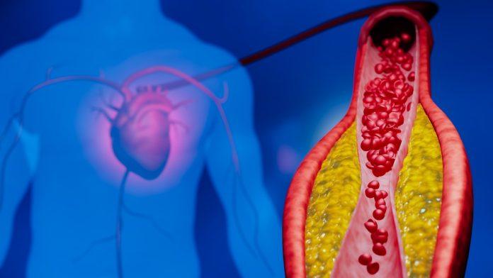 skok-masnoca-u-krvi-nakon-jela:-koliko-brzo-raste-nivo-holesterola-i-triglicerida