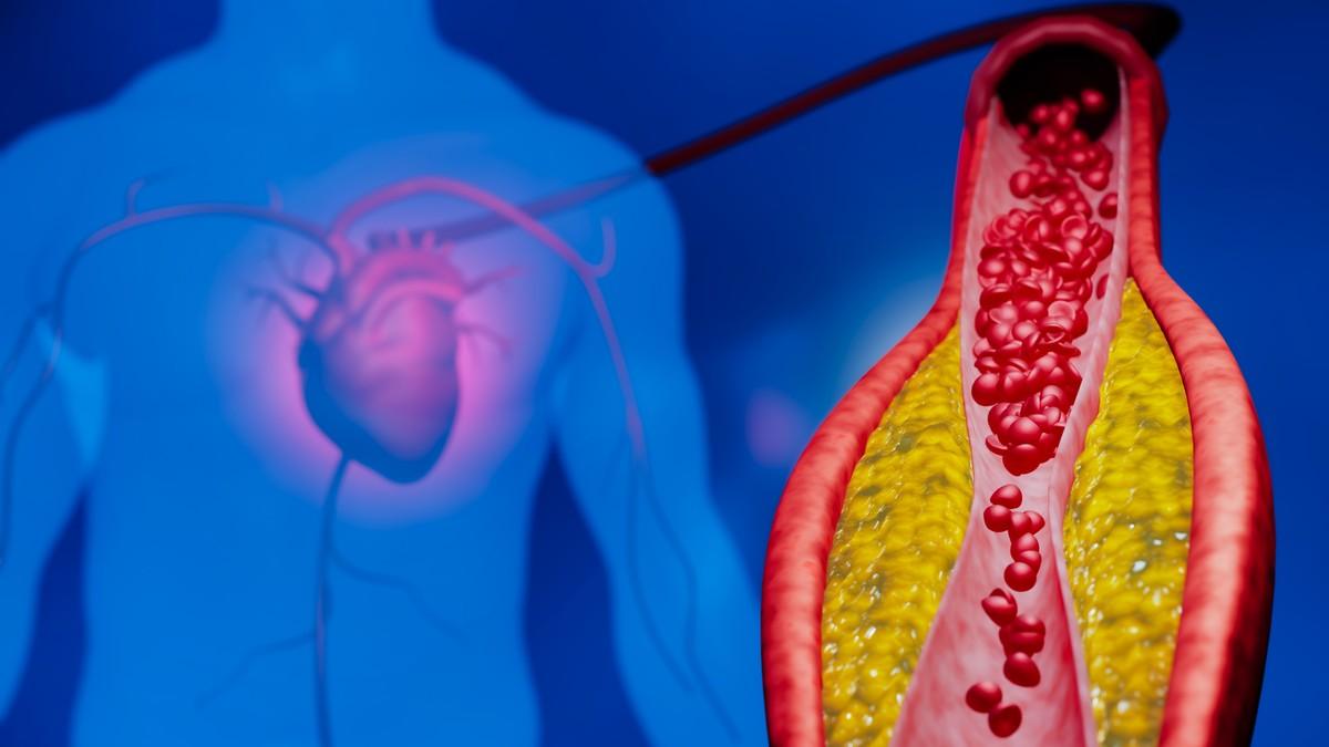skok-masnoca-u-krvi-nakon-jela:-koliko-brzo-raste-nivo-holesterola-i-triglicerida skok-masnoca-u-krvi-nakon-jela:-koliko-brzo-raste-nivo-holesterola-i-triglicerida