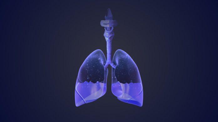 kada-tecnost-zarobi-pluca-–-kako-maligni-pleuralni-izliv-utice-na-prognozu-raka:-karcinomi-kod-kojih-se-javlja-ova-ozbiljna-komplikacija