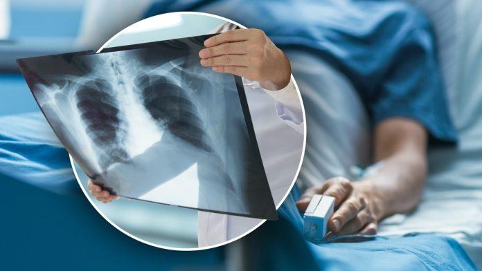 transplantirana-prva-pluca-na-svetu-sa-hiv-pozitivne-na-hiv-pozitivnu-osobu