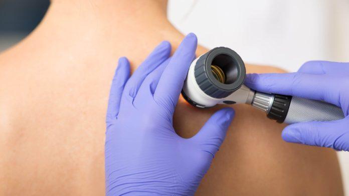 ozbiljan-broj-karcinoma-koze-otkriven-u-prijepolju:-masovan-odziv-na-preventivne-preglede